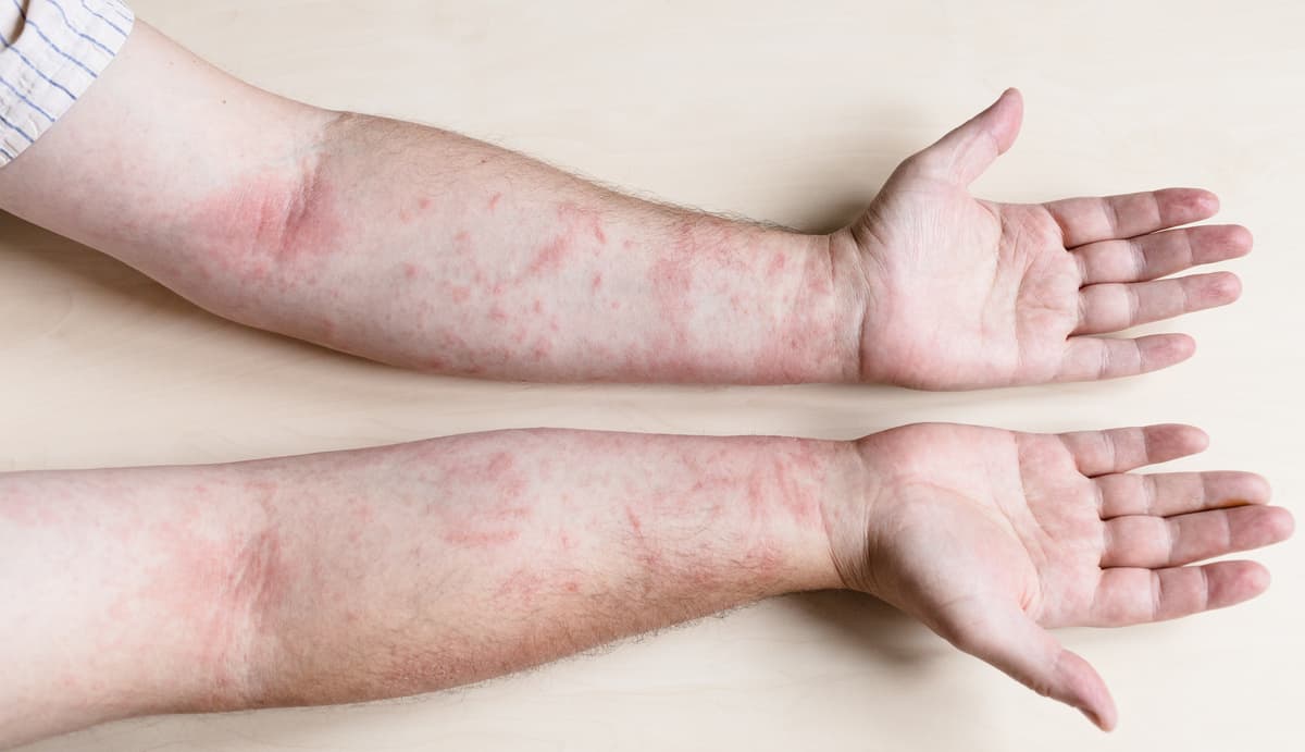 ¿Te salen ronchas o sarpullido al tomar el sol? Descubre los síntomas de la alergia al sol (dermatitis solar), sus causas y cómo tratarla.
