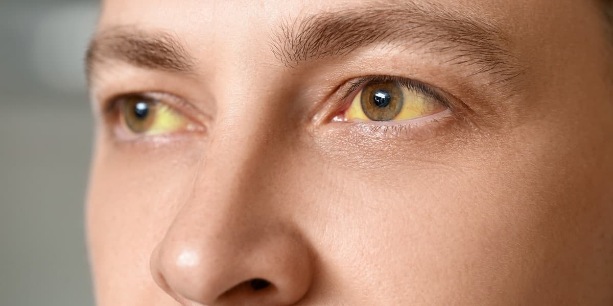 Hepatitis: tipos, contagio y tratamiento