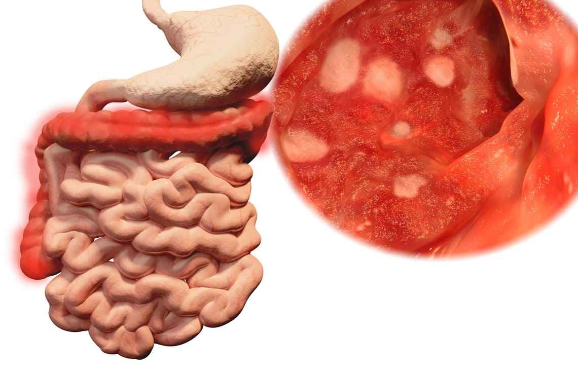 Qué es la colitis ulcerosa