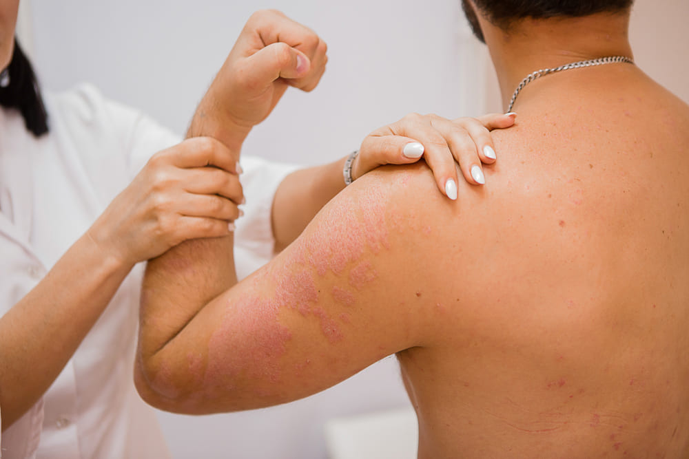 Qué son las enfermedades autoinmunes de la piel y qué tipos existen