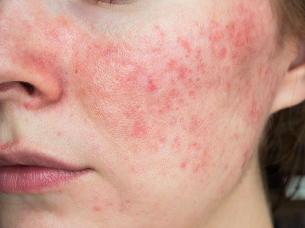 Causas de la rosacea y consejos para tratarla