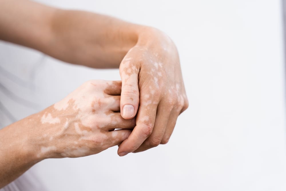Qué es el vitiligo, guía y tratamientos efectivos