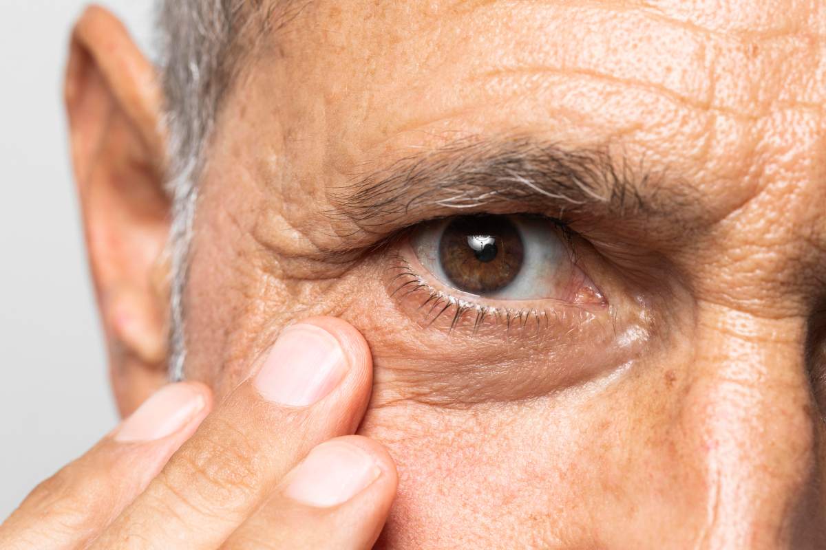 Conoce los síntomas del melanoma uveal, cómo se diagnostica y los tratamientos disponibles para prevenir complicaciones en tu salud ocular.