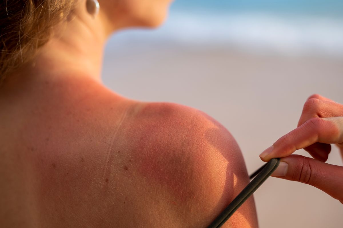 Descubre qué hacer si te has quemado por el sol, cómo aliviar la piel dañada y los cuidados para evitar complicaciones y acelerar la recuperación.