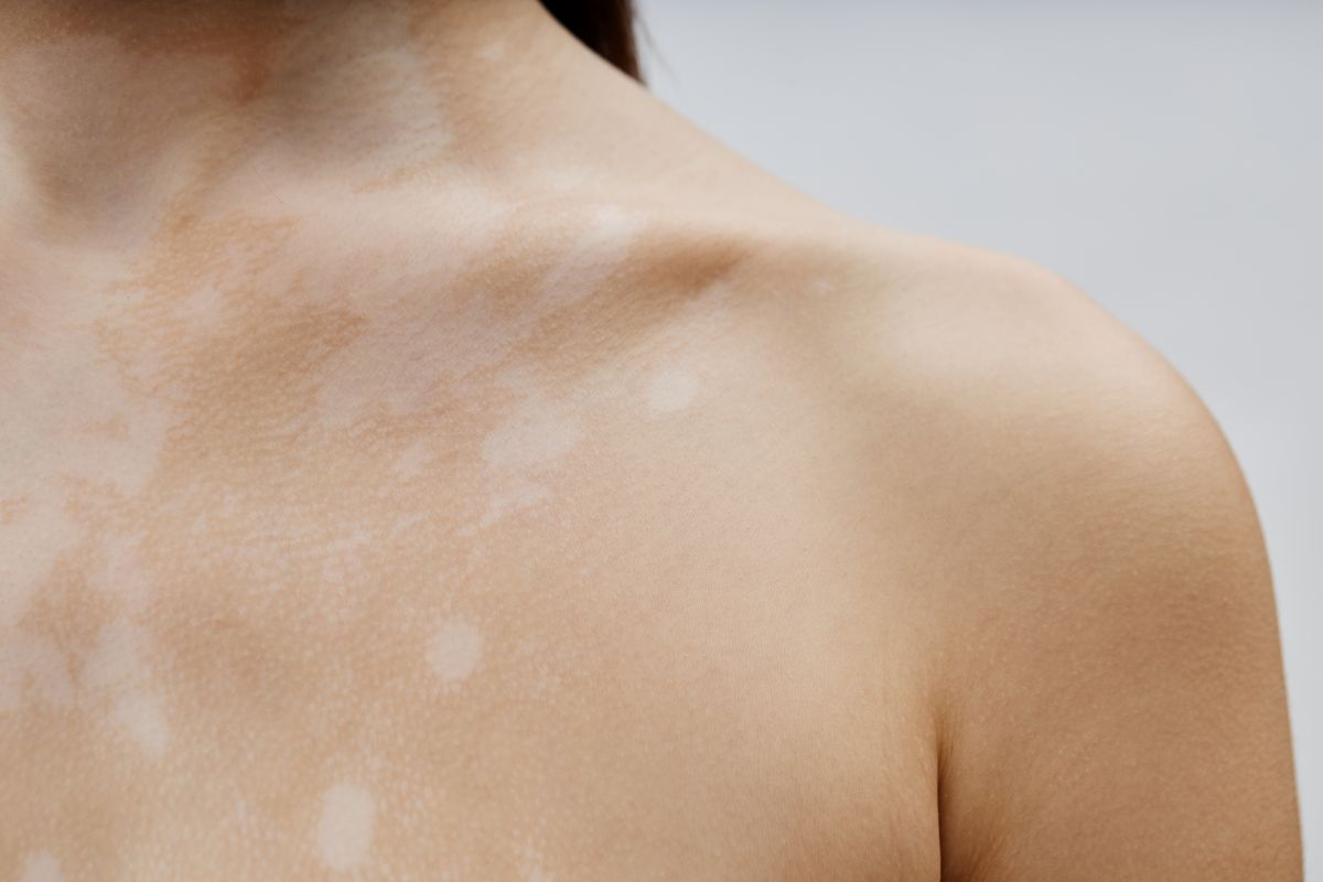 Conoce los síntomas y el contagio de la pitiriasis versicolor y descubre las mejores formas de prevenir y tratar esta infección cutánea.