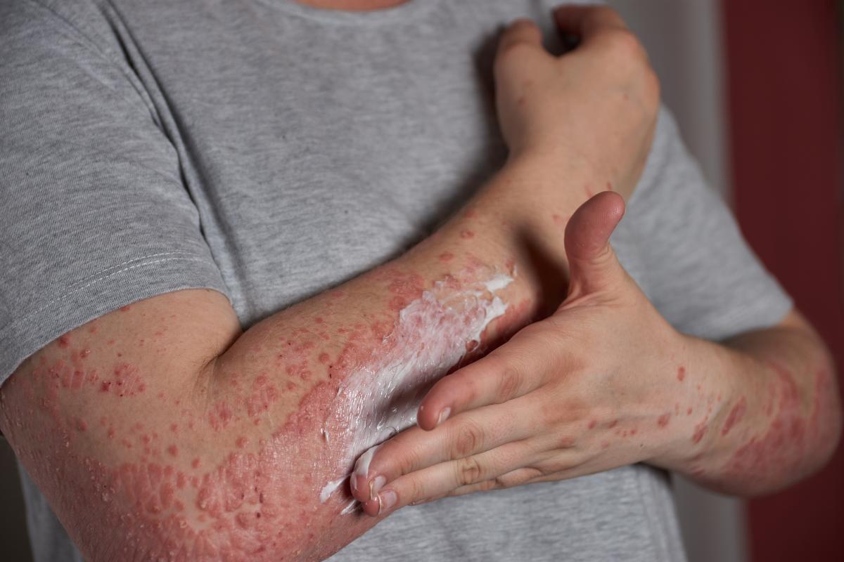 El exantema viral puede ser causado por diversos virus. Conoce sus síntomas, los tipos más comunes y cómo tratarlo. Toda la información aquí.
