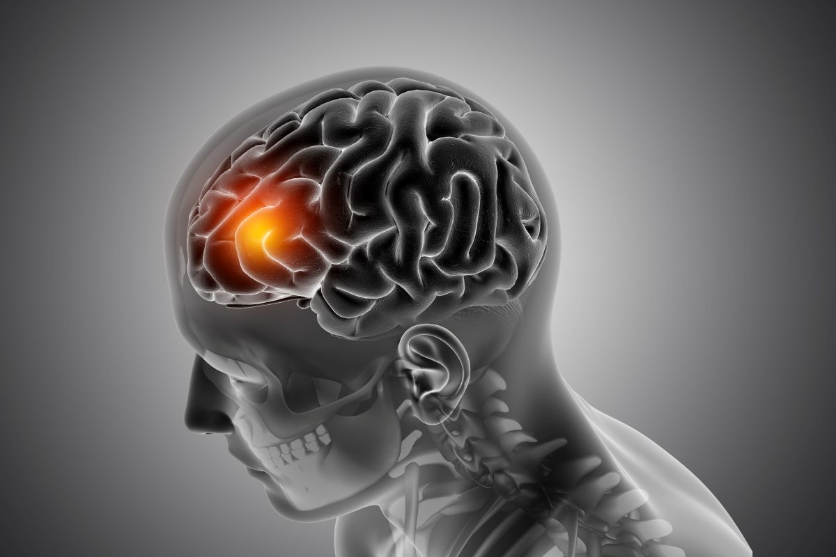 Descubre qué es un fallo cerebrovascular, sus síntomas comunes, factores de riesgo y tratamientos disponibles. Aprende cómo prevenirlo.