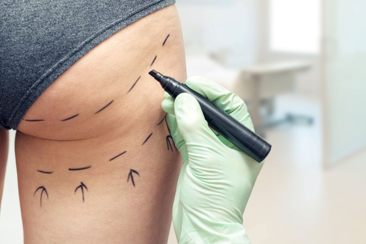 Todo sobre la lipotransferencia de glúteos: qué es, cómo se realiza y los resultados que puedes esperar. Descubre los cuidados postoperatorios.