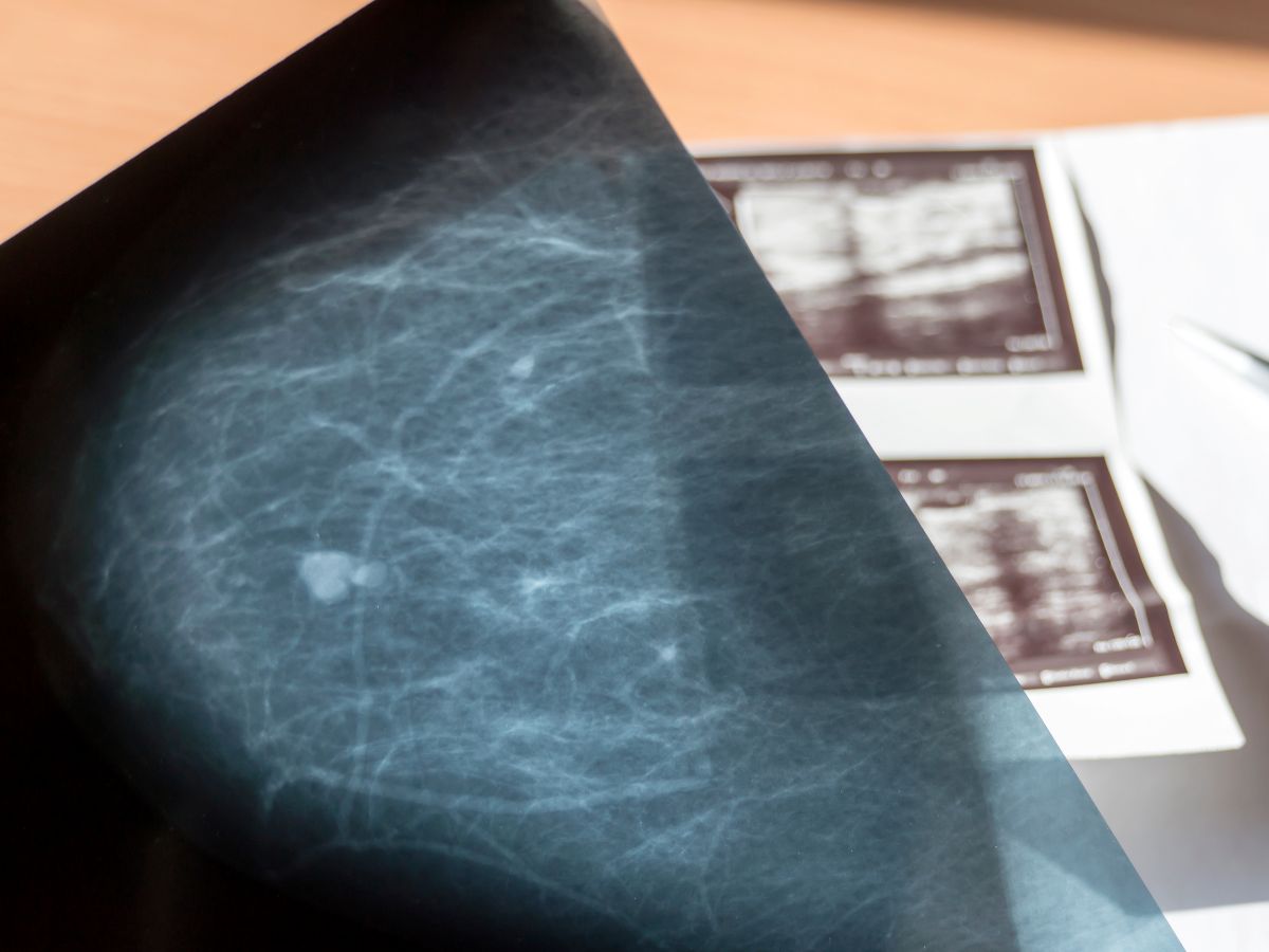 ¿Tiene un fibroadenoma? Conozca los síntomas y la clave de la ecografía. Entienda las variantes complejas, el pronóstico y el mejor manejo clínico.