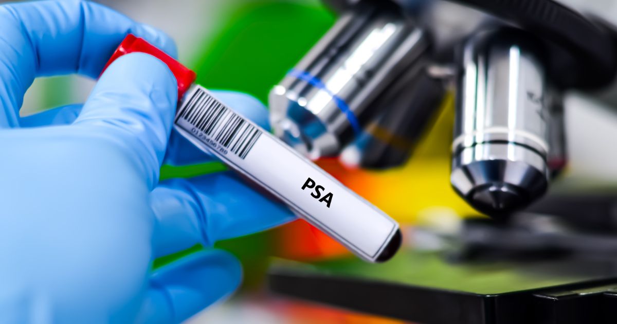 ¿Dudas con tus niveles de PSA? Conoce qué es el Antígeno Prostático Específico, cuáles son sus valores normales por edad y qué factores pueden elevar los resultados.