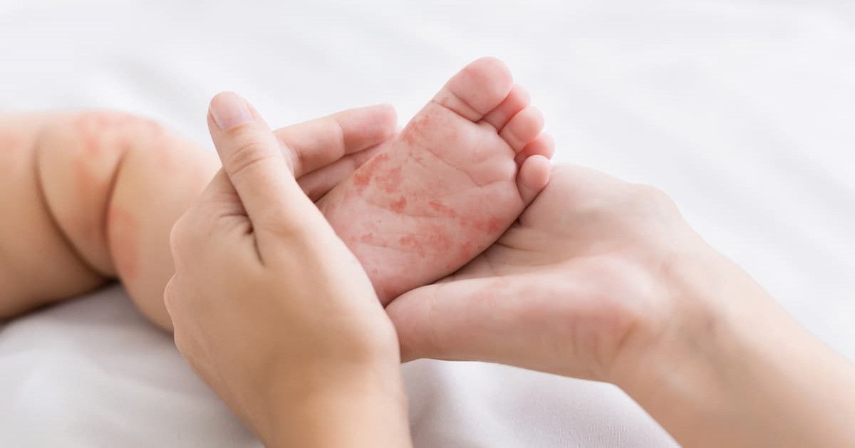 Descubre qué es la rubeola, sus síntomas principales, formas de contagio y tratamiento. Protege tu salud y la de tu familia con esta guía médica.
